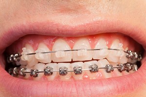 Aparaty ortodontyczne dla dorosych: jak wybra waciwy? [© Sergey Novikov - Fotolia.com]