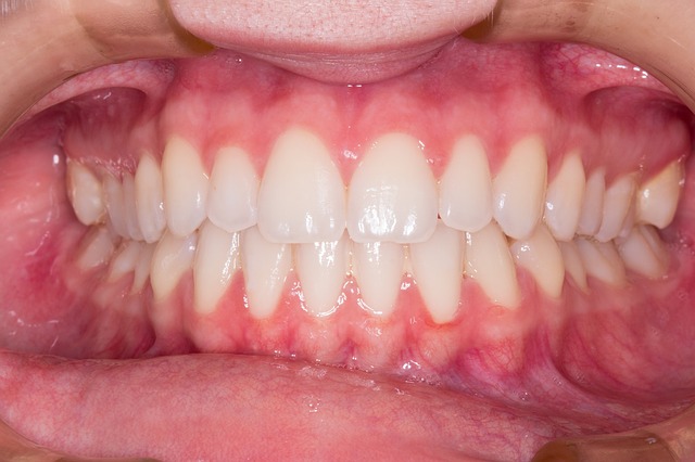 Choroby jamy ustnej mog nasila nadcinienie [fot. alexandreest from Pixabay]