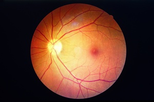 Cukrzyca moe skra wzrok - retinopatia cukrzycowa [© koolsabuy - Fotolia.com]