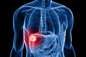 Cukrzyca zwiksza ryzyko raka wtroby [© Sebastian Kaulitzki - Fotolia.com]
