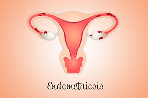 Endometrioza: objawy, diagnoza, leczenie [© sognolucido - Fotolia.com]
