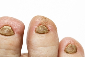 Grzybica paznokci - jakie s objawy, jak unikn infekcji [Fot. nataba - Fotolia.com]