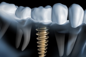 Implanty: "drugie zby" w dojrzaym wieku [© psdesign1 - Fotolia.com]