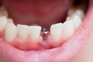Implanty stomatologiczne - w Polsce tanio [©  AnnaMoskvina - Fotolia.com]