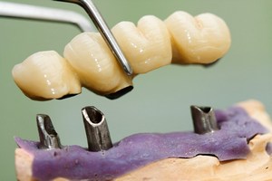 Implanty stomatologiczne: prawdy i mity [© Sandor Kacso - Fotolia.com]