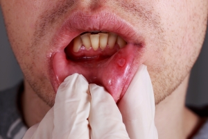 Infekcje bakteryjne jamy ustnej zwikszaj ryzyko chorb serca [Fot. deviddo - Fotolia.com]