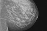 Interwaowy rak piersi zwiksza ryzyko innych nowotworw [© Kelpfish - Fotolia.com]