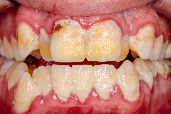 Jak stan zbw i jamy ustnej wpywa na zdrowie caego organizmu [Fot. Dirk - Fotolia.com]