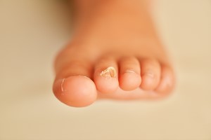 Leczenie grzybicy paznokci: laser alternatyw wobec lekw [© muro - Fotolia.com]