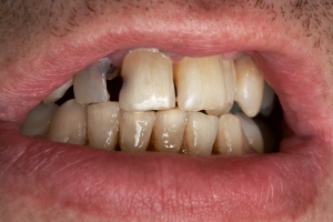 Mae zmiany w ustach, due zmiany w organizmie [Fot. terex - Fotolia.com]