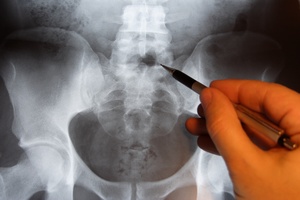 Menopauza a osteoporoza [© luxpainter - Fotolia.com]