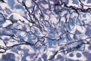 Mielofibroza - nieznany nowotwr z cikim przebiegiem [fot. Novartis]