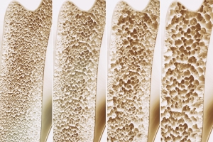 Osteoporoza - co warto wiedzie o „cichym zodzieju koci”? [Fot. crevis - Fotolia.com]