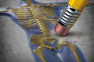 Osteoporoza [© freshidea - Fotolia.com]