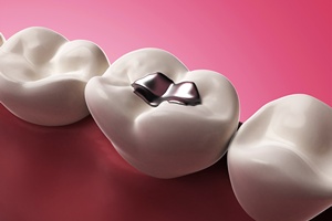 Plomby amalgamatowe: zagroenie w ustach? [© Sebastian Kaulitzki - Fotolia.com]