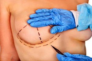 Powikszanie piersi: implanty czy lipofilling? [Fot. Gennadiy Poznyakov - Fotolia.com]