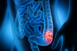 Rak jelita grubego: w diagnostyce pomaga genetyka [© psdesign1 - Fotolia.com]