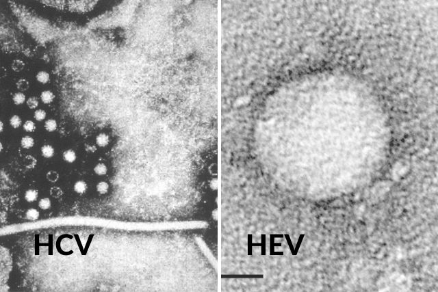 Wirus zapalenia wtroby typu C hamuje wirus typu E [fot. collage Senior.pl / Canva]